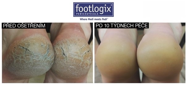 pedi 1